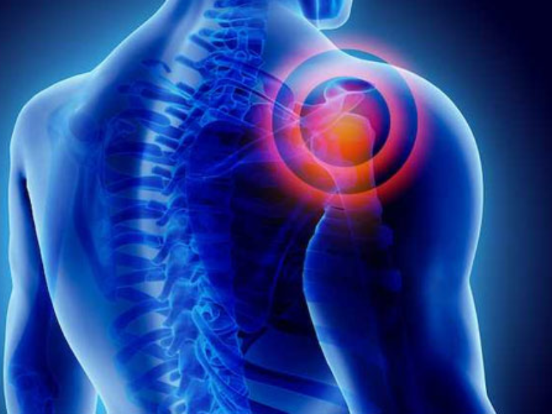  Frozen shoulder